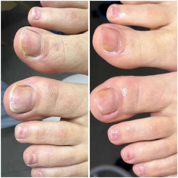 Limpeza / Podoprofilaxia